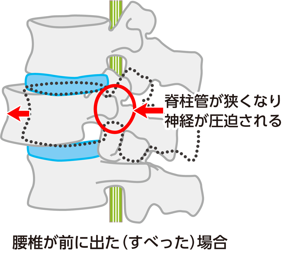 腰椎変性すべり症
