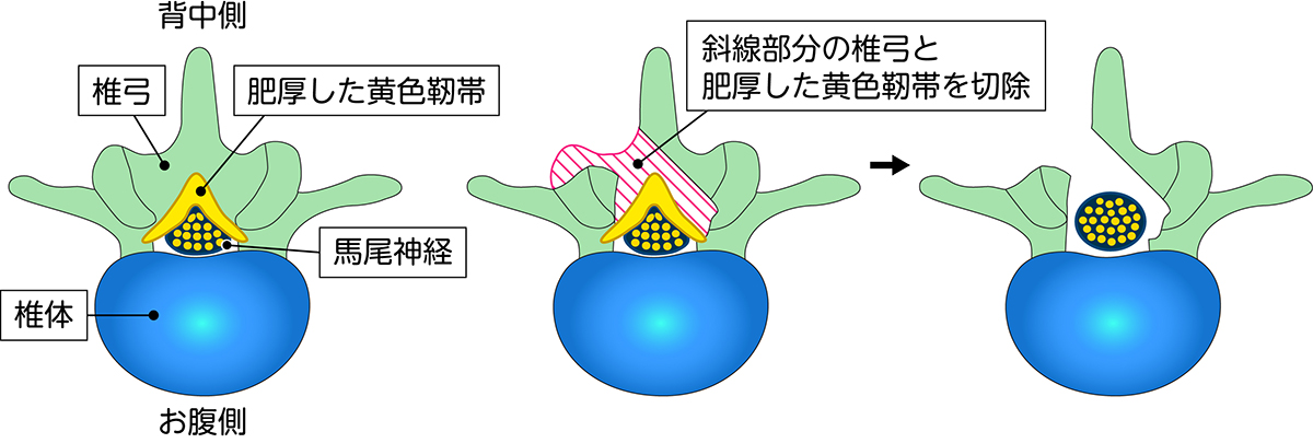 顕微鏡下低侵襲除圧術