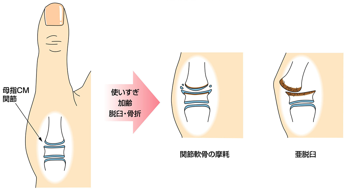 母指CM関節症