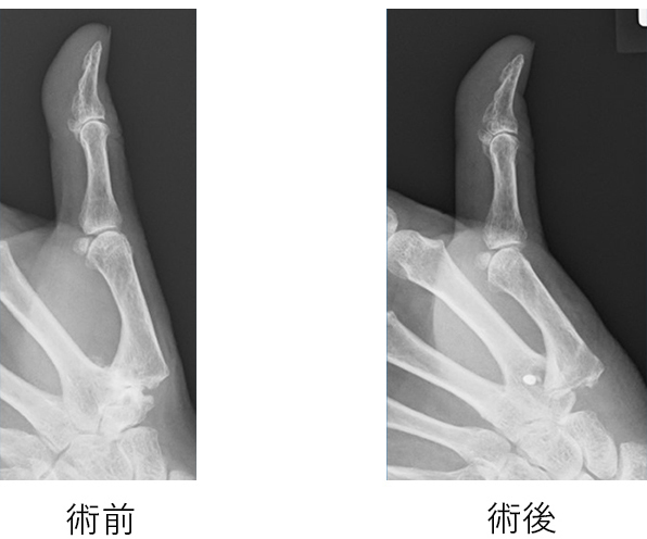 保存療法