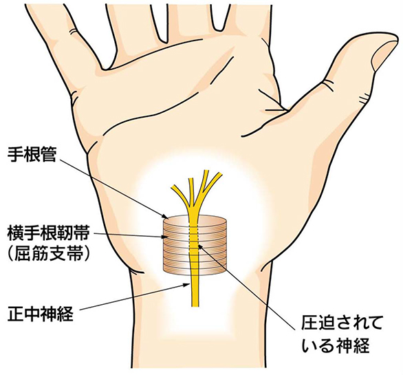 手根管症候群