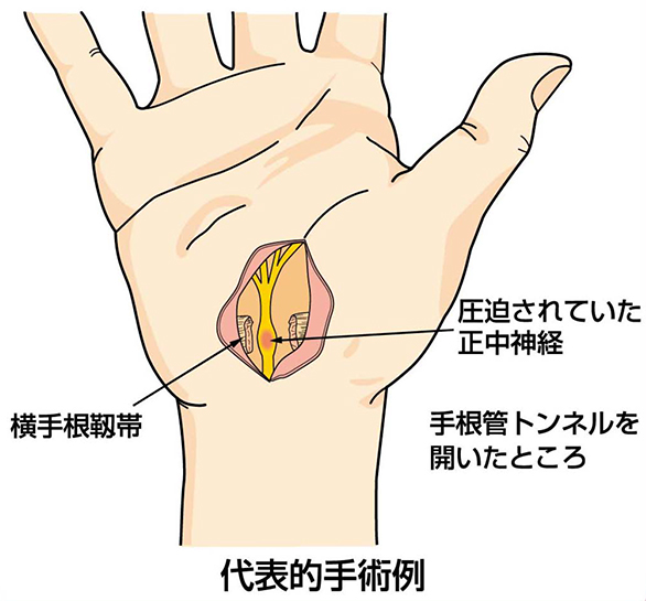 手術療法
