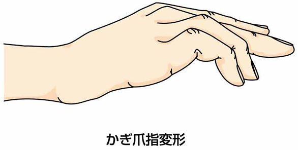 変形