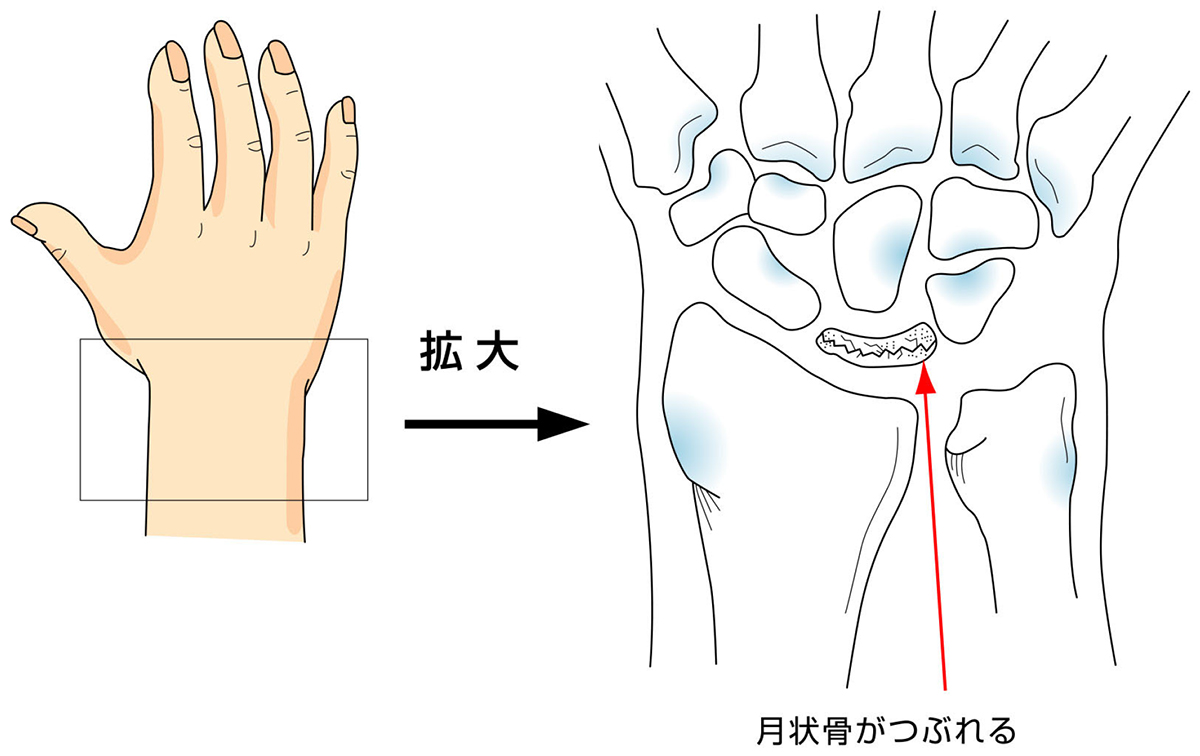 キーンベック症