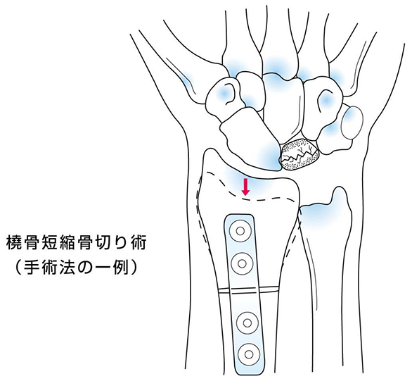 手術療法