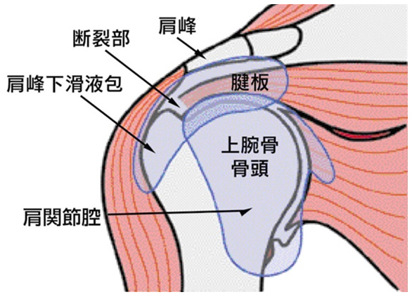 腱板断裂