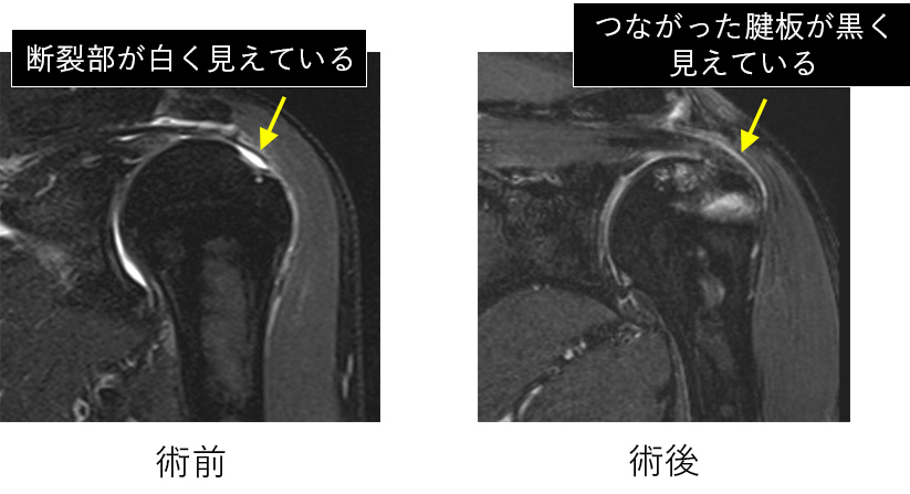 直視下手術