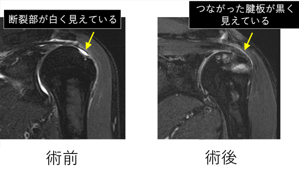 直視下手術
