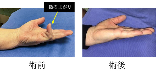 腱膜切除