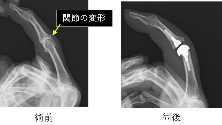 ブシャール結節（人工指関節）