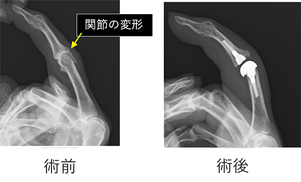 ブシャール結節（人工指関節）