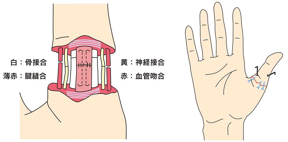 切断指再接着